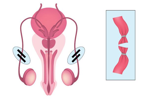Vasectomie: qu'est-ce que c'est, procédure, avantages