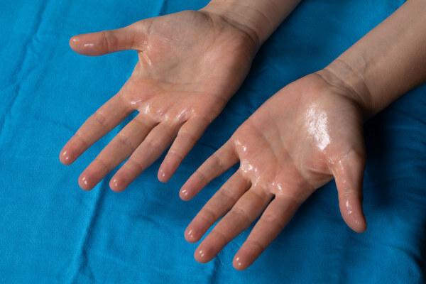אצל אנשים רבים יש הזעה רבה על הידיים, מה שגורם להם להימנע למשל מלחיצת ידיים.