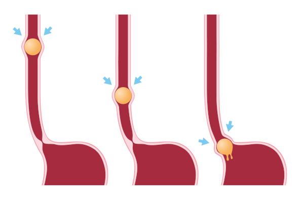  Contracțiile peristaltice promovează mișcarea bolusului alimentar.