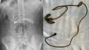 Läkare är chockade över föremålet som fanns i magen på en tonåring