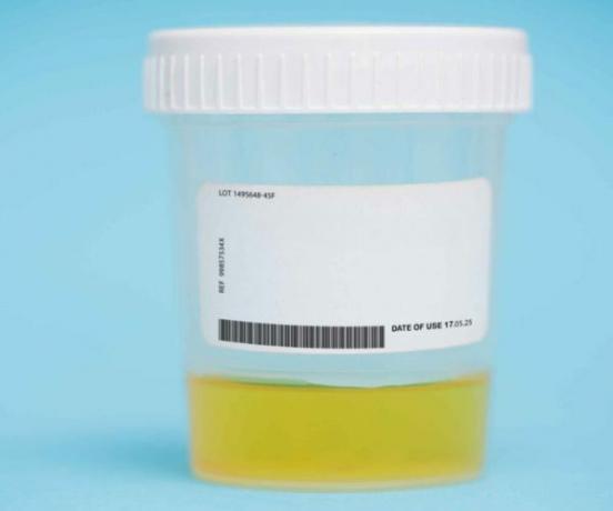 Pregled urina v besedilih o rabdomiolizi.