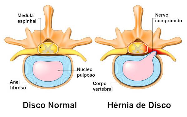 Herniated disc: what is it, causes, symptoms