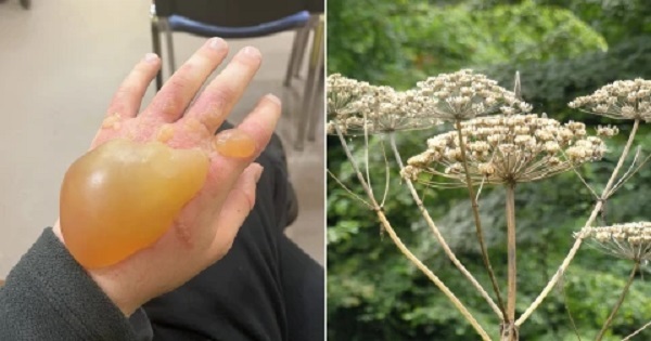 Ο έφηβος αποκτά γιγάντια φουσκάλα και λιποθυμά αφού αγγίξει ένα δηλητηριώδες φυτό
