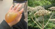 Teenager gets giant blister and faints after touching poisonous plant