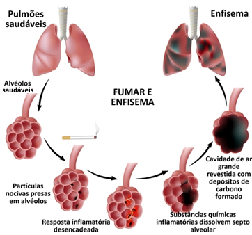Emphysema caused by smoking