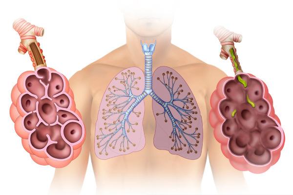 pulmonary emphysema, the alveolar walls are destroyed, compromising oxygen uptake.