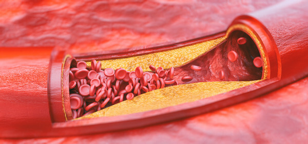 The formation of atherosclerotic plaques causes the artery to narrow.