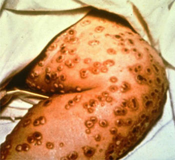 Bubonic Plague: what it is, symptoms and transmission