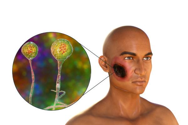 Mukormikoza može uzrokovati nekrozu kože i nepca.