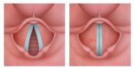 Larynx: značilnosti, funkcije in laringitis