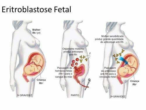 Erythroblastosis fetalis ali hemolitična bolezen novorojenčka
